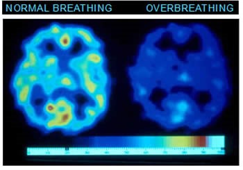 Normal Breathing and Over Breathing - Bohr Effect. Dr David Beales.